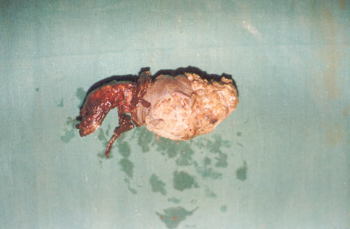 Penil Amputation Specimen